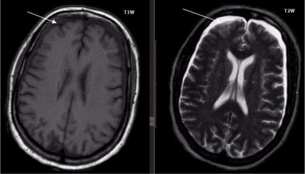 Diagnostic axial brain MRI comparing T1-weighted (T1W) and T2-weighted (T2W) sequences. The images demonstrate a thin, crescentic subdural collection extending bilaterally across the frontoparietal convexities. On the T1W sequence (left), the collection is hypointense (dark) relative to the gray matter. On the T2W sequence (right), the collection is markedly hyperintense (bright), mimicking the signal intensity of cerebrospinal fluid. White arrows on both images highlight the anterior extent of the collection. The wide distribution and signal characteristics are indicative of a subdural effusion or empyema (SDE). There is a slight effacement of the underlying cortical sulci without significant midline shift or ventricular compression at this level. This comparison illustrates the importance of multi-sequence imaging in identifying extra-axial fluid collections and differentiating their composition based on signal intensity changes.