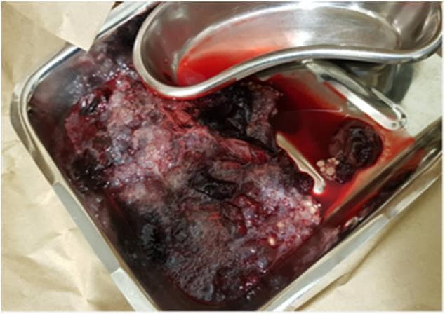 This clinical photograph shows a gross specimen of uterine contents expelled from a patient, presented in a stainless steel kidney dish and larger tray. The specimen demonstrates the classic gross appearance of a hydatidiform mole, a form of gestational trophoblastic disease. Visible pathology includes a large, heterogeneous mass composed of numerous small, translucent, grape-like vesicles (hydropic villi). These vesicles are intermixed with dark red-to-purple tissue and fresh blood. Small, dark fibrin clots are also visible within the fluid and adherent to the vesicular mass. The presence of these clusters of thin-walled cysts is a hallmark diagnostic feature often described as a 'bunch of grapes' appearance. This image illustrates the macro-pathology of molar pregnancy, highlighting the cystic swelling of the chorionic villi and associated intrauterine hemorrhage, which is clinically significant for the diagnosis and management of abnormal first-trimester vaginal bleeding.