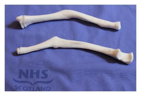 This clinical photograph displays two physical, 3D-printed anatomical models of human forearm bones, identified as the radius and ulna, placed on a blue surgical drape. These models represent patient-specific anatomy derived from CT scan data for preoperative planning. The models demonstrate clinical pathology, specifically a significant mid-shaft malunion of the forearm bones. This is characterized by a prominent bony apex and dorsal angulation (approximately 40 degrees) along the diaphysis, which contributes to restricted pronation and supination. Visible landmarks include the proximal radial head and the distal ulnar styloid process and head. The educational focus is on the application of 3D rapid prototyping in orthopedic surgery to visualize complex bony deformities, such as malunited fractures, which aid in the preparation for corrective osteotomies. The models serve as tangible specimens for assessing anatomical distortion and planning precise surgical correction.