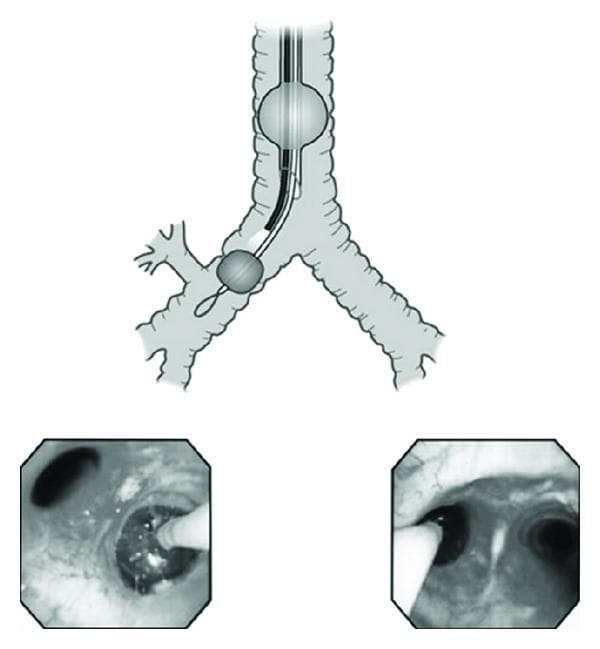 Educational medical graphic demonstrating the placement of a bronchial blocker for one-lung ventilation (OLV). The image consists of a central schematic illustration and two lower endoscopic views. The schematic depicts a single-lumen endotracheal tube (ETT) with its cuff inflated in the trachea above the carina. Through this ETT, a bronchial blocker is advanced into the right main bronchus; its distal balloon is inflated to occlude the airway, approximately 10mm below the carina. The left endoscopic image provides a distal view within the bronchus, showing the blocker's tip and guidewire loop. The right endoscopic image provides a proximal view from the trachea, showing the carina and the blocker entering the left main bronchus. This visual resource illustrates the proper depth and orientation required to achieve lung isolation while maintaining airway access via a single-lumen tube, a critical technique in thoracic anesthesia and surgery.