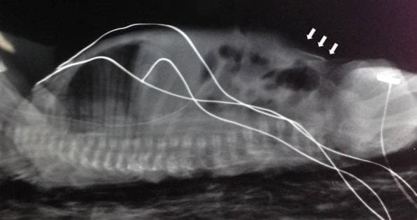 A lateral x-ray radiograph of a neonatal patient in a supine position, highlighting a rare complication of parenteral therapy. The image shows the vertebral column, ribs, and cranial structures of the infant. Prominent white arrows point to an abnormal radiopaque collection in the superficial layers of the abdominal wall, consistent with the extravasation of Total Parenteral Nutrition (TPN). Several thin, radiopaque medical lines (likely EKG leads or infusion tubing) cross the field of view over the chest and abdomen. A medical monitoring electrode is visible on the right side of the frame near the infant's shoulder or head region. The radiograph demonstrates a significant soft tissue density increase and swelling at the site of the extravasation, illustrating a critical iatrogenic injury in a neonatal intensive care unit (NICU) setting. This image serves as an educational tool for identifying catheter-related complications and the radiographic appearance of subcutaneous fluid infiltration in neonates.