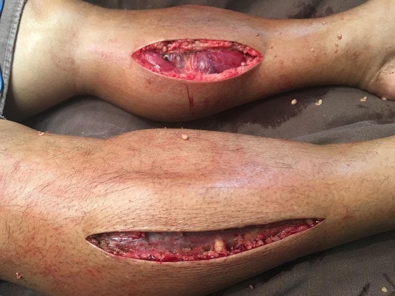 This clinical photograph displays a bilateral lower limb fasciotomy performed to treat acute compartment syndrome. The image shows two lower legs with longitudinal surgical incisions. The upper leg exhibits a wide, elliptical incision over the anterolateral aspect, revealing viable, bulging muscle tissue with a deep reddish-purple hue and no evidence of necrosis. The lower leg shows a more linear, elongated incision along the medial aspect, exposing underlying fascial planes and muscle fibers which appear paler and slightly translucent. These open incisions illustrate the surgical decompression of the four anatomical compartments of the lower leg (anterior, lateral, superficial posterior, and deep posterior). The visible extrusion of the muscle through the skin openings demonstrates the release of high intracompartmental pressure. This visual is significant for teaching emergency surgical management of compartment syndrome and recognizing healthy versus ischemic muscle tissue post-decompression.