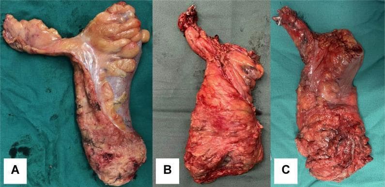 This clinical photograph shows a side-by-side comparison of three resected colorectal surgical specimens, demonstrating the grading of mesorectal integrity following Total Mesorectal Excision (TME) or Rectal Mesenteric Dissection (RMD). Specimen A (Complete) exhibits a bulky, intact mesorectum with a smooth, continuous peritoneal surface and ample fatty tissue covering the rectal tube, indicating a clean dissection along the avascular plane. Specimen B (Nearly Complete) shows a generally intact mesorectum with minor irregularities or superficial defects in the fatty envelope, but without exposure of the muscularis propria. Specimen C (Incomplete) displays significant disruption of the mesorectal fat with deep gouges, irregular contours, and visible exposure of the underlying rectal wall muscle. This visual comparison serves as an educational tool for oncological surgery to assess the quality of the circumferential resection margin and the completeness of lymphadenectomy, which are critical prognostic factors for local recurrence in rectal cancer management.