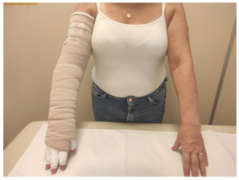 Clinical photograph of a patient undergoing treatment for upper limb lymphedema, likely following breast cancer-related interventions. The image demonstrates a side-by-side comparison between a treated left arm and an untreated right arm. The left arm is encased in a multi-layer compression bandaging system (CB), utilizing beige short-stretch bandages applied in a spiral, overlapping pattern. The bandaging extends from the axilla down to the hand, with individual white cotton gauze or padding applied to the fingers to manage digital swelling. The treated limb exhibits increased bulk due to the therapeutic padding and compression materials, which typically include a cotton stockinet and foam padding layers beneath the external bandages. The right arm serves as a baseline, showing natural morphology and skin tone. This visual illustrates the clinical application of Complete Decongestive Therapy (CDT) in its intensive phase, focusing on mechanical reduction of limb volume through graduated compression.