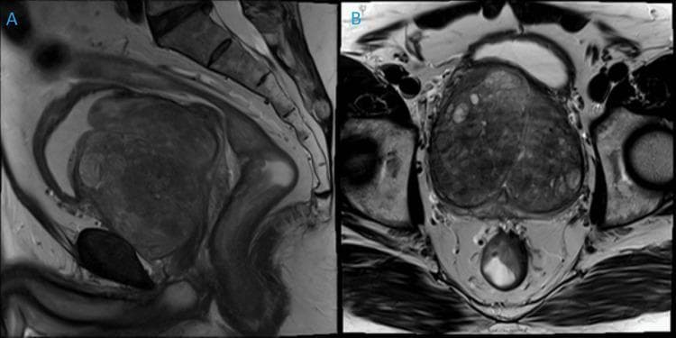 Diagnostic Magnetic Resonance Imaging (MRI) of the male pelvis in sagittal (A) and coronal (B) planes, demonstrating massive benign prostatic hyperplasia (BPH). The prostate gland is severely enlarged, documented at 372g, showing marked expansion of the transition zone. In the sagittal view (A), the prostate is seen inferior to the urinary bladder and anterior to the rectum, occupying a dominant portion of the pelvic cavity and causing superior displacement of the bladder base. The coronal view (B) highlights the heterogeneous signal intensity within the gland, characteristic of stromal and glandular nodules in BPH, without suspicious focal lesions indicative of malignancy. The surrounding pelvic floor musculature and bladder neck are clearly identifiable. This imaging serves as an educational example of extreme prostatic enlargement and its anatomical impact on adjacent pelvic structures, relevant to urological surgical planning such as Holmium Laser Enucleation of the Prostate (HoLEP).