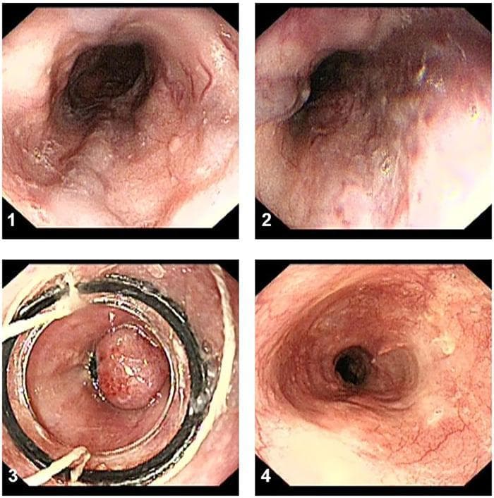This set of four endoscopic images illustrates the stages of Endoscopic Variceal Ligation (EVL) for the management of esophageal varices. (1, 2) Baseline diagnostic images show multiple, large, tortuous, serpentine esophageal varices with visible 'red signs' (cherry red spots), indicating a high risk of imminent hemorrhage. (3) Procedural view showing the application of multiband ligators; a variceal cord is successfully suctioned into the ligator cap and strangulated with an elastic rubber band, forming a polypoid pseudo-polyp. (4) Follow-up surveillance endoscopy performed 3 months post-procedure demonstrates successful eradication of the varices. The esophageal lumen is patent with a smoother mucosal surface and visible white scarring (fibrosis) at the previous ligation sites, which represents healed tissue and reduced vascular engorgement. This sequence serves as a clinical guide for gastroenterology training in the identification, interventional treatment, and post-procedural healing of portal hypertension-induced variceal disease.