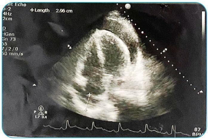 This diagnostic image is a transthoracic echocardiogram (TTE) in an apical four-chamber view. It reveals a significant, circumferentially distributed, echo-free (anechoic) space between the parietal and visceral pericardium, diagnostic of a large pericardial effusion. A measurement call-out on the screen indicates a fluid pocket depth of 2.96 cm. Pathognomonic signs of cardiac tamponade are suggested by the apparent compression of the right-sided heart chambers. At the bottom of the display, a synchronized electrocardiogram (ECG) lead shows the patient's heart rhythm, with a recorded heart rate of 87 BPM (beats per minute). This visual is critical for teaching the ultrasonographic identification of life-threatening pericardial fluid accumulation and its hemodynamic impact on ventricular filling. The clinical relevance involves the immediate need for pericardiocentesis in the setting of cardiovascular compromise.