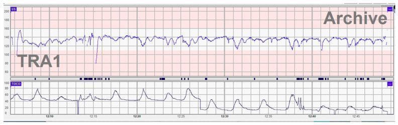 This diagnostic image shows a continuous cardiotocograph (CTG) strip, a vital tool in obstetrics for monitoring fetal well-being during labor. The upper panel displays the fetal heart rate (FHR) tracing, which shows a baseline between 120 and 140 beats per minute (bpm). Notably, the tracing exhibits severely diminished or absent beat-to-beat variability, a clinical sign often associated with fetal distress or a non-reassuring fetal status. Several variable decelerations are present, including a significant prolonged deceleration reaching approximately 80 bpm around the 12:15 timestamp. The lower panel displays the tocodynamometer (TOCO) tracing, representing uterine activity. It shows regular contractions occurring approximately every 3 to 5 minutes, each lasting roughly 60 seconds, with varying peak intensities (amplitudes) between 40 and 80 mmHg. This combination of decreased FHR variability and recurrent decelerations in the context of active labor is an important educational example of a Category II or III FHR pattern requiring close clinical correlation and potentially urgent intervention.