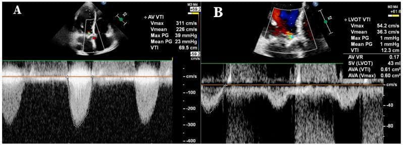 This diagnostic image consists of two panels (A and B) from a transthoracic echocardiogram (TTE) using Doppler ultrasound to evaluate a patient for aortic stenosis. Panel A demonstrates continuous wave (CW) Doppler across the aortic valve, showing a systolic, envelope-shaped spectral tracing below the baseline. Measurements indicate a maximum velocity (Vmax) of 311 cm/s and a mean pressure gradient of 23 mmHg, which are typically associated with non-severe gradients. Panel B shows pulsed wave (PW) Doppler of the left ventricular outflow tract (LVOT). The clinical significance lies in the calculated aortic valve area (AVA) of 0.61 cm² and an LVOT velocity time integral (VTI) of 12.3 cm. These findings highlight a 'low-flow, low-gradient' aortic stenosis phenotype, where the calculated valve area indicates critical stenosis despite relatively low pressure gradients and velocities. This comparison is an essential educational tool for understanding discordant echocardiographic parameters in valvular heart disease.