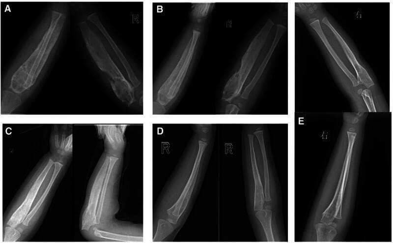 A series of five pediatric X-ray panels (A-E) illustrating the longitudinal progression and resolution of spina ventosa (tuberculous dactylitis) in the right ulna. Panel A (initial presentation) shows dramatic expansile remodeling of the ulnar shaft, characterized by significant bone expansion, thinned cortical bone, and a disorganized, cystic-like trabecular pattern. Panel B shows persistent expansion with an initial increase in radiodensity following intervention. Panel C demonstrates a marked reduction in bone diameter, ulnar remodeling, and cortical thickening. Panel D shows nearly complete resolution of the expansile lesion with restoration of normal bone mineral density. Panel E (final follow-up at 3.5 years old) confirms complete cortical and medullary restoration, exhibiting normal ulnar morphology and a smooth periosteal surface. The series demonstrates the typical radiological evolution of bone tuberculosis under successful antituberculous therapy, moving from extensive bone destruction and expansion to complete structural normalization.