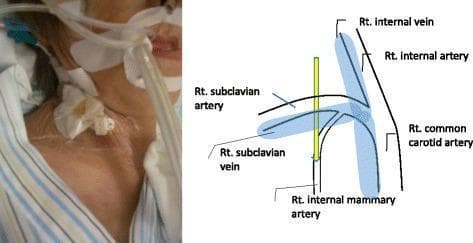 This procedural content consists of a side-by-side clinical photograph and an anatomical diagram illustrating a central venous catheter (CVC) malposition. The left panel is a clinical photograph of a patient's right neck and supraclavicular region, showing an intubated patient with a CVC dressing and medical tubing. The right panel is a schematic diagram of the right-sided vascular anatomy in the neck and upper chest. Labeled structures include the right subclavian artery and vein, right internal jugular vein (labeled as 'Rt. internal vein'), right common carotid artery, and the right internal mammary artery (IMA). A yellow vertical line represents a catheter inserted via a supraclavicular approach. The diagram demonstrates a potential mechanism of iatrogenic injury where the catheter, intended for the subclavian vein, is instead directly inserted into the more deeply seated right internal mammary artery due to a proximal insertion site. This visual serves as an educational tool for anesthesiology and vascular medicine to demonstrate the anatomical risks and potential complications of landmark-guided central venous access.