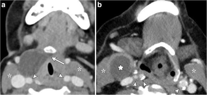 This dual-panel axial contrast-enhanced CT of the neck provides a side-by-side comparison of two distinct congenital cystic neck masses. Image A illustrates a thyroglossal duct cyst presenting as a well-circumscribed, hypoattenuating mass. It is located anterior to the carotid sheath vessels (indicated by arrowheads) and anteromedial to the sternocleidomastoid muscle (indicated by asterisks). A diagnostic 'tail sign' or medial extension (arrow) toward the hyoid bone is visible, characteristic of thyroglossal duct remnants. Image B demonstrates a second branchial cleft cyst (indicated by a star) in a similar lateral neck position. This lesion is rounded, thin-walled, and fluid-filled, located adjacent to the right sternocleidomastoid muscle (asterisks) and lateral to the carotid space. Unlike the thyroglossal duct cyst, the branchial cleft cyst lack a medial extension to the hyoid bone. Both images emphasize the importance of anatomical landmarks, such as the relationship to the carotid vessels and the presence of a medial tract, in differentiating these common pediatric and young-adult neck pathologies.