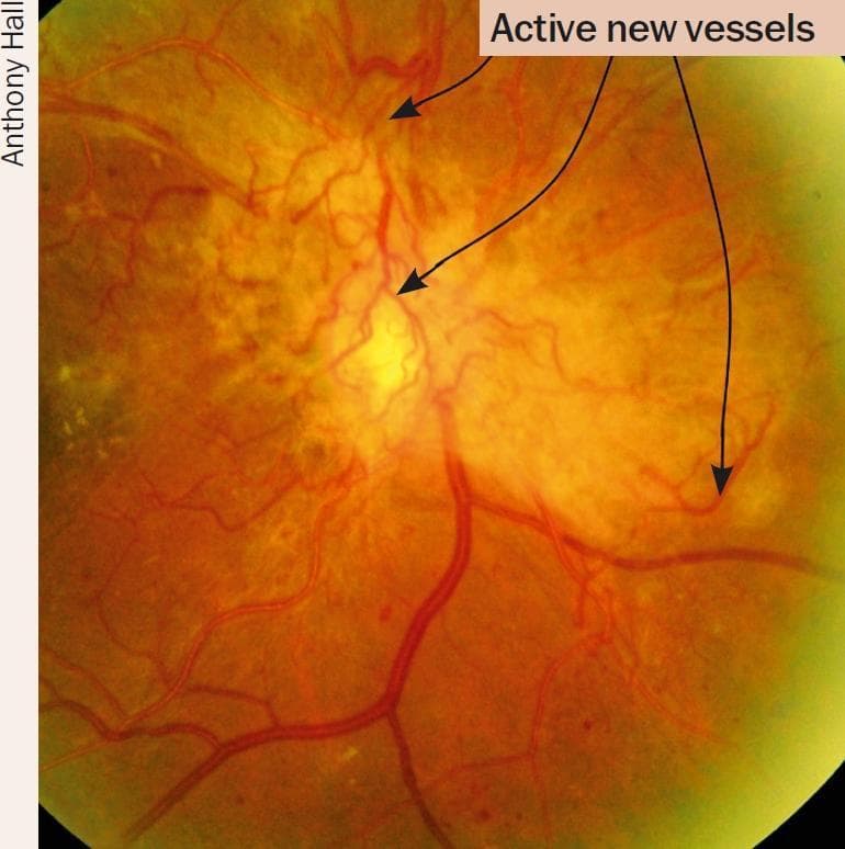 This clinical fundus photograph illustrates the hallmarks of Proliferative Diabetic Retinopathy (PDR). The primary findings are several areas of active neovascularization, specifically neovascularization of the disc (NVD) and neovascularization elsewhere (NVE), indicated by arrows pointing to fine, tufted, and tortuous capillary-like vessels. These new vessels are shown proliferating from the retina and extending onto the posterior vitreous surface. The retinal background exhibits additional signs of diabetic microvascular disease, including small, dark-red punctate lesions consistent with microaneurysms or small dot-and-blot hemorrhages. There are also subtle, lighter-colored yellowish patches suggestive of hard exudates. The overall retinal appearance is mottled, indicating underlying ischemia and chronic vascular damage. This image serves as a clinical example of advanced diabetic eye disease where pathological angiogenesis poses a high risk for vitreous hemorrhage and tractional retinal detachment.
