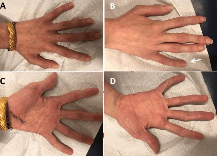Clinical photograph of a patient's hands in dorsal (A, B) and palmar (C, D) views, demonstrating characteristic features of a connective tissue disorder. The image shows significant arachnodactyly, characterized by abnormally long and slender fingers. In panel B, a white arrow indicates clinodactyly (radial curvature) of the fifth digit. The palmar views (C, D) reveal thin palms with visible superficial veins and elongated phalanges. The fingers also exhibit signs of joint hypermobility/hyperextensibility at the metacarpophalangeal and interphalangeal joints. These musculoskeletal findings are classically associated with conditions such as Marfan syndrome or related genetic connective tissue diseases. The skin appears of normal texture without edema, though the hands show evidence of diffuse muscle wasting consistent with distal weakness.