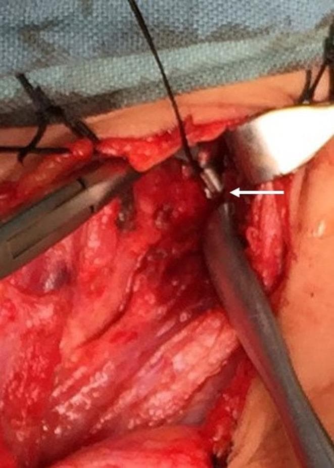 This clinical photograph captures an intraoperative view of a surgical neck dissection for the management of a recurrent pyriform sinus fistula (PSF). The surgical field shows exposed deep cervical fascia and soft tissues. A white arrow points to the remaining fistula tract, which appears as a small, cylindrical, pale-colored tubular structure a few millimeters in diameter. Key surgical instruments in the field include a Senn retractor being used on the right to provide lateral traction for better visualization of the deeper structures, and hemostatic forceps or a clamp on the left manipulating adjacent tissue. Black silk sutures are visible at the superior margin of the incision. The image illustrates the complex anatomy and the surgical challenge of identifying and excising the complete tract in recurrent cases to prevent future infection or abscess formation.