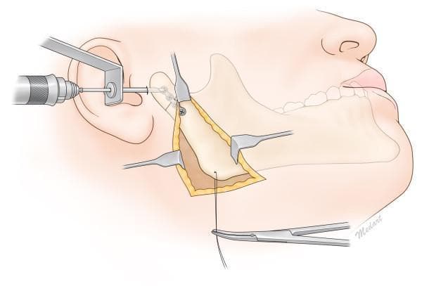An anatomical illustration demonstrating a surgical reduction and internal fixation of a condylar neck fracture using a combined Risdon approach and transcutaneous trochar technique. The visual features an outlined human mandible with a clear fracture line across the condylar neck. A submandibular (Risdon) incision is shown with surgical retractors exposing the mandibular ramus and the fracture site. A miniplate (osteosynthesis plate) is positioned across the fracture line. A transcutaneous trochar and drill/driver system are depicted entering through the preauricular/cheek area to provide perpendicular access for screw insertion into the condylar segment. Concurrently, surgical needle holders or forceps are shown inferiorly managing suture material for layered wound closure. This educational diagram illustrates the combined use of direct visualization via a submandibular approach and percutaneous instrumentation to achieve stable fixation in the narrow anatomical space of the upper mandibular ramus.