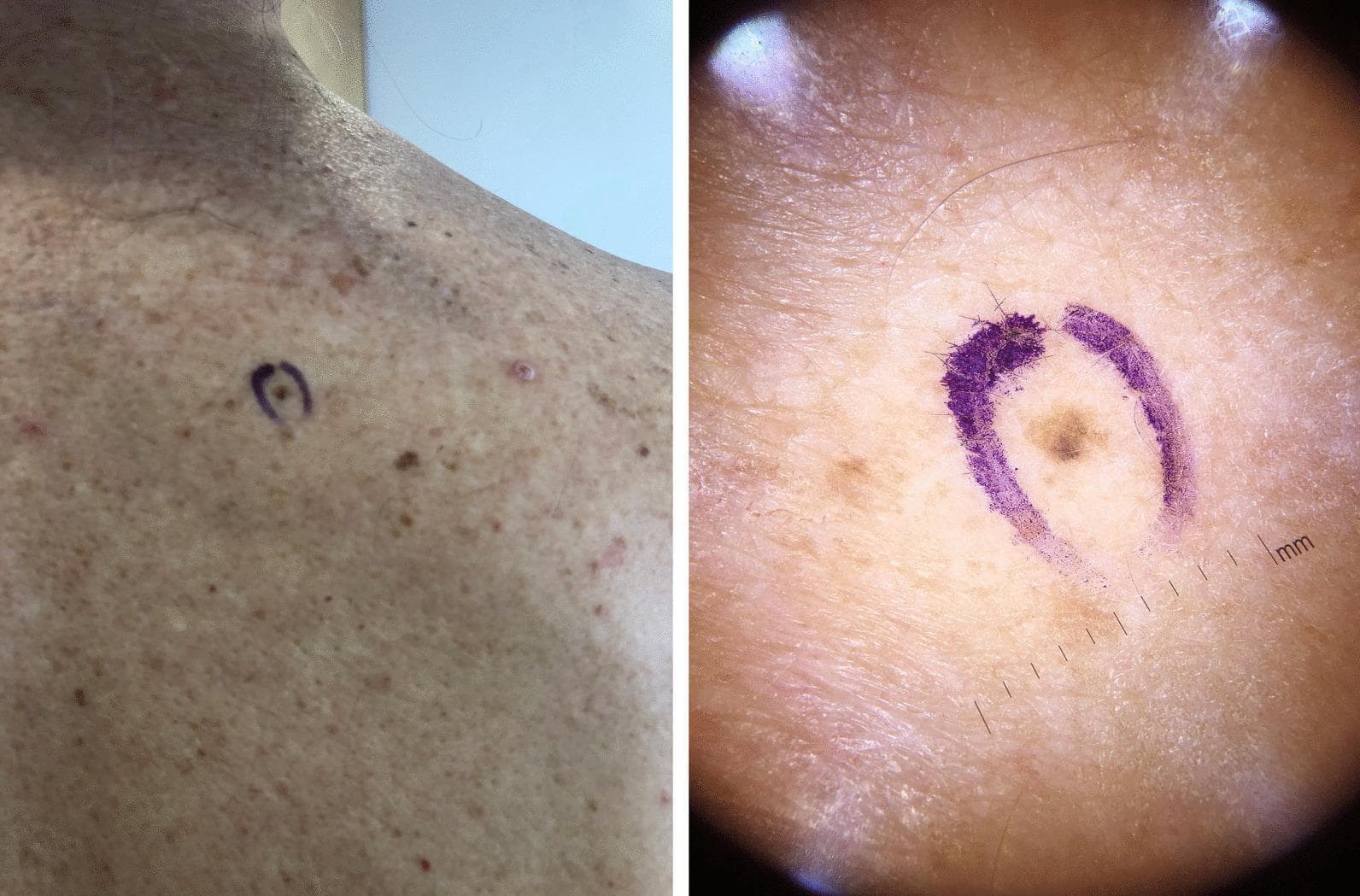 This dual-panel image features a clinical photograph (left) and a dermatoscopic image (right) of a pigmented skin lesion identified as melanoma in situ (MIS). The clinical photograph shows the lesion located on the right scapular region, marked with a purple surgical ink circle. The surrounding skin exhibits actinic damage, characterized by solar lentigines and uneven pigmentation. The dermatoscopic view on the right provides a high-magnification assessment of the same lesion, revealing irregular hyperpigmented areas, varying shades of brown, and poorly defined, asymmetric borders. A millimeter scale is visible at the bottom right of the dermatoscopic frame for size reference, indicating the lesion is approximately 2mm in diameter. The educational focus is on the diagnostic utility of dermatoscopy in identifying early-stage, small-diameter melanomas that may appear as non-specific macules to the naked eye. This content is relevant for dermatology training, specifically in the clinical detection and management of cutaneous malignancies.