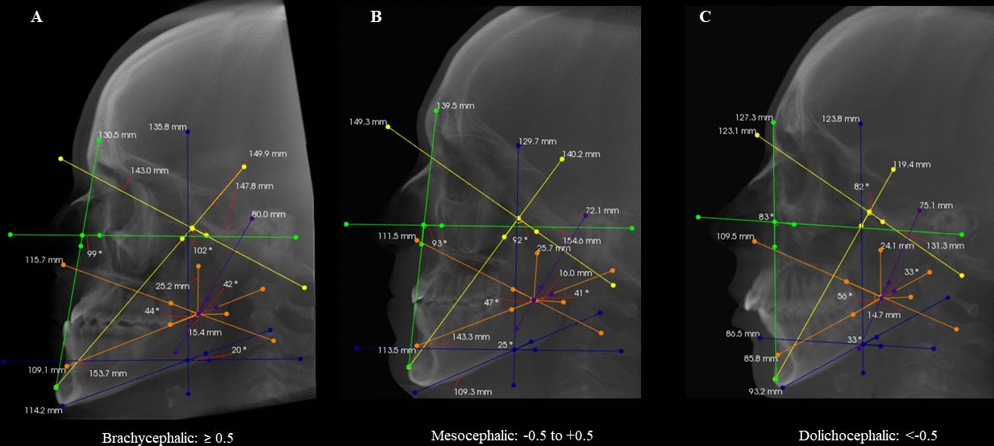 This diagnostic image set consists of three sagittal cone-beam computed tomography (CBCT) reconstructions illustrating cephalometric analysis for different facial types: Brachycephalic (A), Mesocephalic (B), and Dolichocephalic (C). Each scan displays standardized color-coded linear and angular measurements used to calculate the Vert index. Key measurements include: the facial axis (yellow line), facial depth (green line), mandibular plane (blue line), lower facial height (orange line), and mandibular arch (purple line). The images demonstrate the skeletal variation across patterns: the Brachycephalic type shows a shorter, wider facial structure with a flatter mandibular plane and steeper facial axis; the Dolichocephalic type exhibits a vertically elongated, narrower facial profile with a steeper mandibular plane and more acute facial axis. The Mesocephalic reconstruction represents a balanced intermediate skeletal relationship. This comparison is used in orthodontics and maxillofacial surgery to classify facial growth patterns and guide treatment planning for skeletal malocclusions.