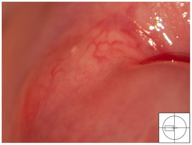 This colposcopic image displays a clinical photograph of the uterine cervix showing a Nabothian cyst. The cyst is visible as a pale yellow, spheroid structure localized within the transformation zone, adjacent to the squamo-columnar junction (demarcated by a dashed line). It exhibits a characteristic elevated surface caused by the retention of mucus beneath the metaplastic squamous epithelium. A distinct vascular network is draped over the cyst's surface; these mucosal blood vessels show regular branching patterns and appear to be pushed aside or stretched by the underlying cystic mass. This benign finding serves as an important differential diagnosis for other cervical mucosal lesions, such as the homogenous sandy patches and rubbery papules associated with Female Genital Schistosomiasis (FGS). The image illustrates the typical appearance of a retention cyst in a gynecological context, emphasizing the relationship between smooth surface morphology and regular vascular distribution.
