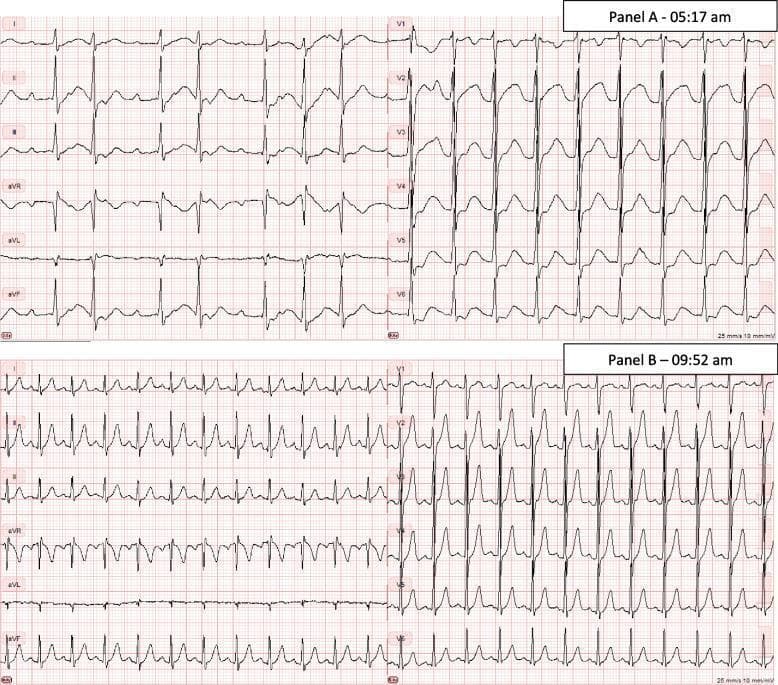 A comparison of two 12-lead electrocardiograms (ECG) labeled Panel A and Panel B, documenting the resolution of rhythm and morphological abnormalities in a patient with thyrotoxic periodic paralysis and severe hypokalemia. Panel A (on admission) demonstrates an irregular rhythm consistent with atrial flutter featuring variable conduction (1:2 and 1:3 block). Morphological markers of hypokalemia are visible, including prominent U-waves fused with T-waves and a flattened or pseudo-prolonged QT interval. Panel B, taken approximately four hours later following oral potassium chloride treatment, shows a transition to a regular sinus tachycardia. The atrial flutter waves have disappeared, replaced by distinct P-waves preceding each QRS complex. The ST-segments and T-waves have largely normalized compared to the baseline hypokalemic tracing. This side-by-side comparison illustrates the dynamic cardiac manifestations of electrolyte derangement (potassium 1.4 mM) and the rapid electrocardiographic improvement upon potassium replacement therapy.