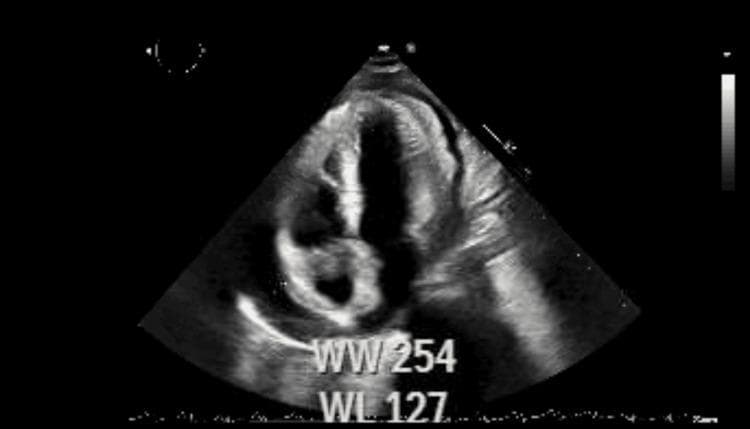 A diagnostic echocardiogram in the apical four-chamber view showing the early hemodynamic signs of cardiac tamponade. The image demonstrates a small-to-moderate circumferential pericardial effusion, visible as an anechoic (dark) space between the hyperechoic pericardium and the epicardium. Key clinical findings include visible compression and diastolic collapse of the right heart chambers, particularly the right atrium and right ventricle, due to increased intrapericardial pressure. There is evidence of abnormal septal motion, often associated with pericardial constriction or tamponade physiology. The overall cardiac silhouette appears slightly distorted by the external fluid pressure. This diagnostic image is intended for intermediate to advanced medical learners to illustrate the pathophysiology of obstructive shock secondary to pericardial effusion and the importance of echocardiography in identifying early signs of cardiac tamponade.