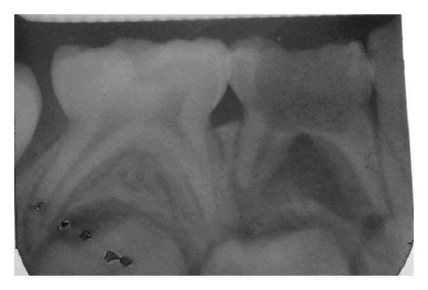 This diagnostic image is an Intraoral Periapical (IOPA) radiograph of the mandibular right molar region in a pediatric patient. The primary focus is on the second primary molar (tooth #84), which exhibits a large, distal radiolucency involving the enamel and dentin, consistent with deep dental caries. Centrally, the pulp chamber appears enlarged and irregular following the removal of a metallic foreign body. Distinctive periapical radiolucency is visible at the root apices, indicative of chronic inflammatory changes such as a dentoalveolar abscess. The surrounding alveolar bone shows signs of rarefaction. The adjacent first primary molar (#83) is visible mesially with a relatively normal crown and root structure. The image serves as an educational example of deep carious lesions, secondary pulpal involvement, and the subsequent periapical bone response in primary dentition. It is relevant for pediatric dentistry and endodontic diagnostic training.