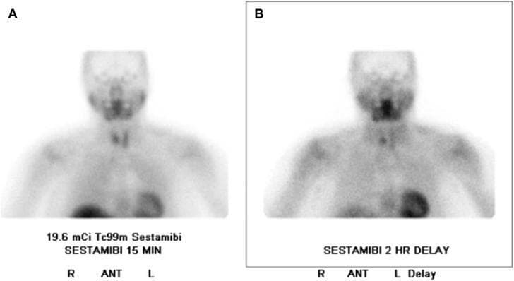 This diagnostic image shows a technetium-99m (Tc99m) sestamibi parathyroid scintigraphy scan in two phases: an early 15-minute scan (A) and a 2-hour delayed scan (B), both presented in the anterior (ANT) view. The study focuses on the neck and upper torso regions. In scan A, initial tracer uptake is visible within the thyroid gland and salivary glands, with a focal area of increased accumulation in the lower right parathyroid region. In the delayed scan B, the physiological tracer activity has partially washed out from the normal thyroid tissue. However, there is persistent, focal radiotracer retention in the lower portion of the right parathyroid gland. This differential washout pattern is a classic scintigraphic finding diagnostic of a parathyroid adenoma. The images utilize nuclear medicine imaging to localize ectopic or hyperfunctioning parathyroid tissue in patients with primary hyperparathyroidism or normocalcemic hyperparathyroidism.