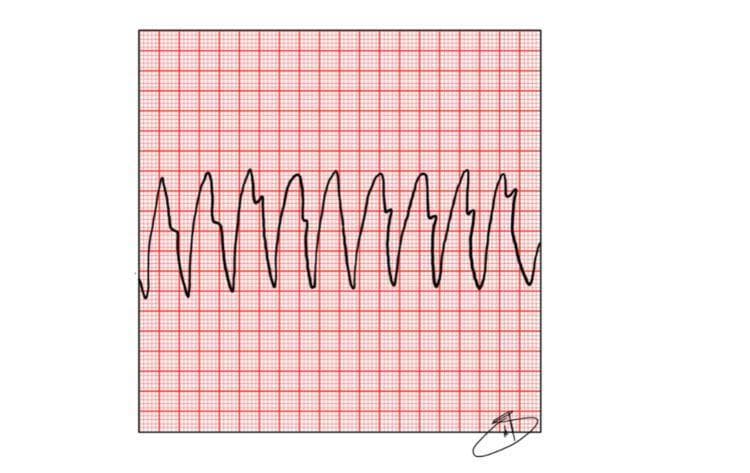 A diagnostic illustration of an electrocardiogram (ECG) rhythm strip displayed on standard red-grid paper. The tracing demonstrates monomorphic Ventricular Tachycardia (VT). Key visual features include a rapid, regular rhythm with wide, bizarrely shaped QRS complexes that lack associated P waves. The QRS complexes exhibit high amplitude and a consistent morphology, characteristic of an ectopic ventricular pacemaker. The intervals between complexes are significantly shortened, indicating extreme tachycardia, typically exceeding 150 beats per minute. There is no visible isoelectric line between the waveforms, and T waves are obscured by the wide QRS complexes. This strip serves as a classic educational representation of a shockable rhythm in the context of Out-of-Hospital Cardiac Arrest (OHCA) and pulseless VT, emphasizing the need for immediate defibrillation and Advanced Cardiovascular Life Support (ACLS) protocols.