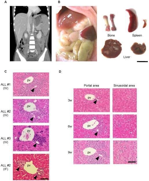 Educational panel demonstrating the clinical and histopathological pathology of Acute Lymphoblastic Leukemia (ALL) in human patients and NOG mouse xenograft models. (A) Coronal CT scan of a human abdomen showing marked hepatosplenomegaly. (B) Macroscopic comparison between normal and leukemic NOG mice organs, highlighting significant splenomegaly, hepatomegaly, and a pale femur (bone marrow) in the leukemic model. (C) H&E-stained histopathological sections of mouse livers across different ALL cases (IV and IF injection routes), showing dense clusters of leukemic lymphoblasts infiltrating the portal areas surrounding the portal vein (pv); arrowheads indicate bile ducts. (D) Sequential histopathological analysis at 3, 6, and 9 weeks post-transplantation, contrasting the progression of leukemic cell accumulation. Large, expanding clusters are visible in the portal area over time, while the sinusoidal areas show only sparse, scattered leukemic cells. This visual evidence supports the portal area as a specific niche for ALL cell harboring and proliferation.