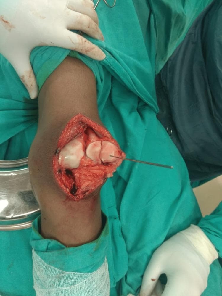 This clinical photograph shows an intraoperative view of an open reduction and internal fixation (ORIF) for a large displaced osteochondral fracture of the patella. The surgical site, accessed via a standard medial parapatellar approach on the left knee, reveals the exposed articular surface and underlying bone. The patellar joint surface is visibly fragmented, showing distinctive smooth, white cartilaginous surfaces characteristic of osteochondral fragments. A thin Kirschner wire (K-wire) or guide pin is seen traversing one of the fragments, serving as provisional fixation to align the fracture before permanent stabilization. The surgical field demonstrates typical hemorrhagic tissue and disrupted soft structures associated with acute traumatic injury. Personnel are depicted in a sterile environment, wearing white surgical gloves and utilizing green surgical drapes. This image is an educational example of orthopedic trauma management, specifically illustrating the visualization of intra-articular knee fractures and the initial steps of mechanical stabilization in a 16-year-old male patient.