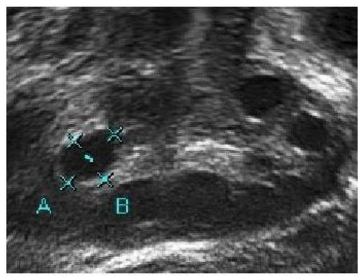 This diagnostic image is a B-mode ultrasound scan of a human ovary, demonstrating characteristic features of Polycystic Ovary Syndrome (PCOS). The image shows multiple hypoechoic (dark) regions representing ovarian follicles. Two specific regions are labeled 'A' and 'B'. Region A is a rounded, anechoic structure marked with measurement calipers to determine follicle size. Region B is a larger, more elongated hypoechoic area situated lower in the stroma. The image quality is characterized by low contrast and significant speckle noise, which is typical for raw clinical ultrasound data before digital enhancement. These factors result in poorly defined follicle boundaries that blend into the surrounding echogenic ovarian stroma. The educational focus of this image is on the visual identification and manual measurement of follicles for PCOS diagnosis, highlighting the technical challenges in distinguishing fluid-filled cysts from adjacent tissue and pelvic capillaries in low-light-intensity ultrasound captures.
