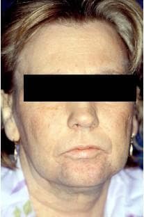 This clinical photograph displays androgenized facial features in a 41-year-old female patient, illustrating the physical manifestations of hyperandrogenism and virilization. Key visible findings include hirsutism, characterized by coarse, dark terminal hair growth on the upper lip, chin, and jawline in a male-pattern distribution. The facial skin exhibits signs of thickening and a roughened texture. The jawline appears relatively prominent and squared, contributing to the overall masculinization of the facial phenotype. Such features in a female clinical context are often associated with systemic endocrine dysfunction, such as paraneoplastic syndromes secondary to hormone-secreting tumors (e.g., Krukenberg tumors or ovarian/adrenal malignancies). This image serves as an educational example of virilization symptoms used in the differential diagnosis of androgen-secreting pathologies in endocrinology and oncology.