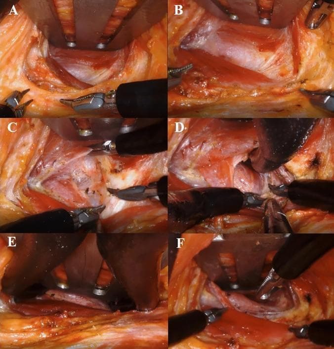 This composite of six intraoperative clinical photographs (A–F) demonstrates a 'two-step retraction' operative procedure for robotic transaxillary thyroidectomy using the da Vinci SP system. A-B: The initial stages show the surgical console view following the first docking, where a narrow skin flap is created and widened using a specialized Chung’s retractor and robotic graspers. C: Robotic instruments are seen dissecting and creating a working space between the sternal and clavicular heads of the sternocleidomastoid (SCM) muscle. D: Deeper dissection reveals the thyroid gland situated beneath the strap muscles. E-F: These frames illustrate the 'second docking' or redocking phase, where the retractor is repositioned deeper (beneath the strap muscles) to optimize the spherical working space for the robotic arms. The series highlights the progression from superficial flap dissection to deep anatomical exposure of the thyroid, emphasizing the minimally invasive approach through a single axillary incision and the specialized manipulation of neck musculature to achieve surgical access.
