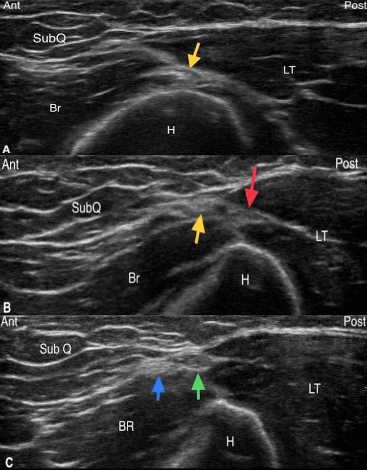 A series of three transverse axis sonographic images (A, B, and C) illustrating the diagnostic tracking of the radial nerve and the posterior cutaneous nerve of the forearm (PCNF) in the lateral brachium. Image A shows the radial nerve (yellow arrow) at the level of the spiral groove, positioned posterolateral to the humerus (H) in the fascial plane between the brachialis (Br) and the long head of the triceps (LT). Image B demonstrates the radial nerve (yellow arrow) distally as it branches into the PCNF (red arrow) after exiting the spiral groove. Image C captures the distal third of the humerus, where the PCNF has subdivided into anterior (blue arrow) and posterior (green arrow) divisions within the lateral triceps-brachioradialis (LT-BR) interval. The ultrasound highlights the hyperechoic surface of the humerus with posterior acoustic shadowing, the intermediate echogenicity of the musculature (Br, LT, BR), and the relatively hypoechoic nerve structures as they move more superficially into the subcutaneous tissue (SubQ) plane.