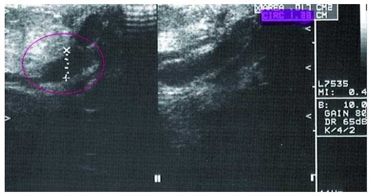 This diagnostic image consists of two side-by-side breast ultrasonography panels demonstrating mammary ductal ectasia. On the left panel, a pink circle highlights a dilated, elongated, and hypoechoic (dark) fluid-filled structure, characteristic of an enlarged lactiferous duct. Calipers are visible within the circle, measuring the transverse diameter of the duct, which appears to contain minor internal echogenic foci or debris. The right panel provides a longitudinal view of the same or a continuous dilated duct, showing its tubular morphology and well-defined but irregular borders against the surrounding heterogeneous, more echogenic fibroglandular stroma. Annotations on the right margin include ultrasound settings (gain, mechanical index) and measurement data. The image serves as a clinical example of benign ductal changes often evaluated in the context of nipple aspirate fluid (NAF) collection or BI-RADS assessment for inconclusive mammographic findings.