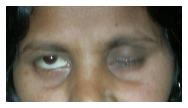 This clinical photograph displays a close-up view of the upper face and eyes of a patient demonstrating Bell's phenomenon, a hallmark sign of peripheral facial nerve paralysis (Bell's palsy). The patient is attempting to close both eyes. On the patient's left side, the eyelid closes normally. However, on the patient's right side, there is evidence of lagophthalmos (incomplete eyelid closure). Upon the attempt to close the right eye, the eyeball rotates upward and outward, a physiological movement that is unmasked by the failure of the orbicularis oculi muscle. This upward displacement exposes a significant portion of the inferior sclera. Additionally, the right side of the forehead appears smooth with a lack of expressive wrinkling compared to the contralateral side, further indicating lower motor neuron facial nerve involvement. This visual finding is critical for differentiating peripheral facial nerve lesions from central causes, where forehead movement is typically spared.