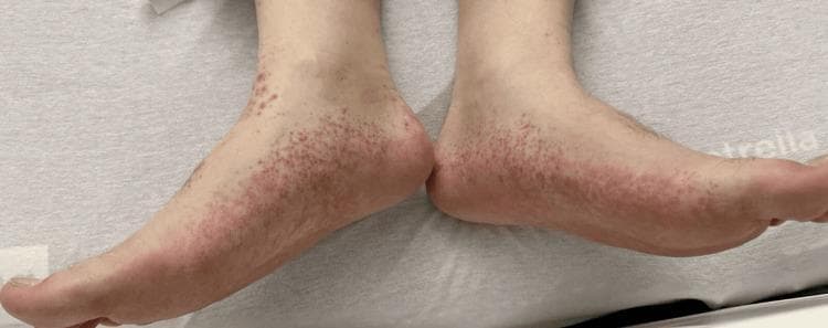 Type: Clinical Photograph. Anatomical Region: Bilateral feet and ankles (medial and lateral aspects). Findings: The image shows a symmetric, dense distribution of numerous small, non-blanching, erythematous to violaceous macules. These lesions are morphologically consistent with petechiae. The distribution is most concentrated around the ankles and heels, extending across the dorsal and lateral surfaces of the feet. The surrounding skin appears otherwise intact with no obvious ulceration, scaling, or crusting, though there is a subtle erythematous background suggesting underlying inflammation. Clinical Significance: These visual findings are characteristic manifestations of small-vessel vasculitis, such as leukocytoclastic vasculitis or Henoch-Schönlein purpura (IgA vasculitis), where cutaneous hemorrhage occurs due to vessel wall inflammation. This image is an educational example of dependent petechiae and purpura, often found in systemic inflammatory or autoimmune conditions.