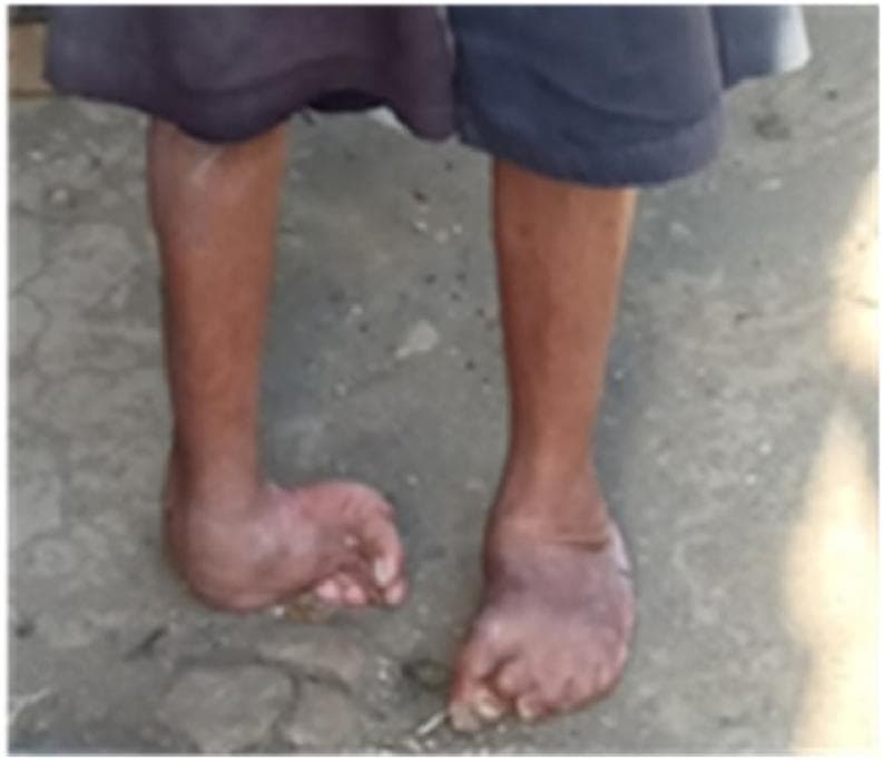 This clinical photograph shows a bilateral lower limb presentation of congenital talipes equinovarus (CTEV), commonly known as clubfoot, in an adult patient. The image illustrates severe structural deformities characterized by forefoot adduction, midfoot cavus, and hindfoot varus. The left foot exhibits more profound involvement, with the foot severely rotated medially (inward) and the weight-bearing surface appearing to be the lateral border of the foot rather than the sole. The right foot shows similar inward angulation and equinus, though less pronounced than the left. Associated muscle atrophy of the lower calves is visible, a common finding in untreated or chronic CTEV. The presentation demonstrates the long-term musculoskeletal impact and abnormal gait mechanics associated with uncorrected congenital foot deformities, highlighting the clinical need for specialized orthopedic intervention or orthotic management to improve stability and weight distribution.