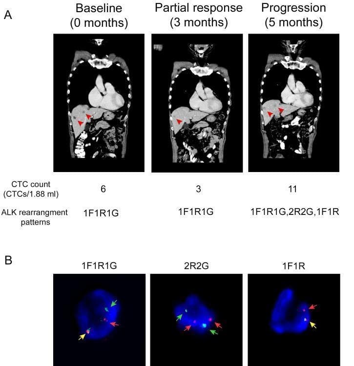 This composite educational image illustrates the clinical application of ALK-rearranged Circulating Tumor Cells (CTCs) as a biomarker for monitoring treatment response in Non-Small Cell Lung Cancer (NSCLC). Panel A presents a series of coronal CT scans of the chest and abdomen at three intervals: baseline (0 months), partial response (3 months), and progression (5 months). Red arrowheads indicate metastatic liver lesions, showing a reduction in size at 3 months followed by significant enlargement at 5 months. Below the scans, longitudinal data tracks the CTC count per 1.88 mL and identifies specific ALK rearrangement patterns. Panel B provides representative Fluorescence In Situ Hybridization (FISH) images of CTCs demonstrating different ALK break-apart signal patterns: 1F1R1G (one fusion, one orange, and one green signal), 2R2G (two orange, two green), and 1F1R (one fusion, one orange). Colored arrows (yellow for fusion, red for orange/R, and green for G) highlight these genetic signatures. The figure demonstrates the correlation between increased CTC counts, diversifying rearrangement patterns, and clinical disease progression during targeted therapy.