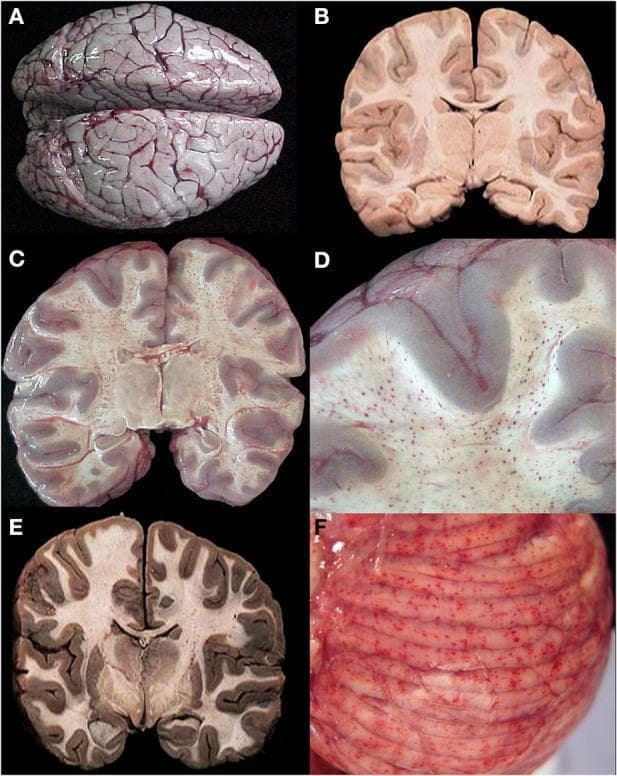This composite of six clinical pathology photographs (A-F) illustrates the gross anatomical features of the brain in cases of fatal cerebral malaria. Panel A shows an external view of a whole brain demonstrating significant cerebral edema, characterized by flattened gyri and narrowed sulci, with a classic 'slate gray' to purple discoloration due to intravascular malarial pigment. Panels B, C, and E present coronal brain slices showing varying presentations: (B) is a control with normal color and no lesions; (C) reveals diffuse petechial 'ring' hemorrhages concentrated in the white matter; and (E) shows intense gray-brown discoloration and swelling without hemorrhages. Panel D is a higher magnification of the cerebral cortex, highlighting the sharp demarcation between the hemorrhagic white matter and the unaffected cortical gray matter. Panel F shows a gross external view of the cerebellum with prominent, diffuse petechial hemorrhages visible on the surface of the folia. This sequence educates on the histopathological variations of cerebral malaria (CM1 and CM2), emphasizing sequestration, vascular congestion, and microvascular injury.