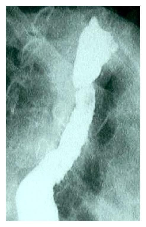 This diagnostic image is an esophageal barium swallow (contrast radiography) demonstrating classic features of esophageal intramural pseudodiverticulosis (EIP). The radiopaque contrast material highlights a significant focal narrowing in the upper esophagus, consistent with a proximal esophageal stricture. Associated with this stricture, multiple small, flask-shaped, or linear collections of contrast are visible running parallel to the esophageal wall. These represent dilated excretory ducts of the deep esophageal mucosal glands that have filled with barium, creating a characteristic 'dotted line' or 'pseudodiverticula' appearance. The image serves as a clinical example of EIP, a condition often associated with chronic inflammatory processes such as Candida esophagitis or chronic gastroesophageal reflux. This imaging is crucial for gastroenterology and radiology education, illustrating the typical radiographic morphology used to distinguish intramural pseudodiverticula from true esophageal diverticula.