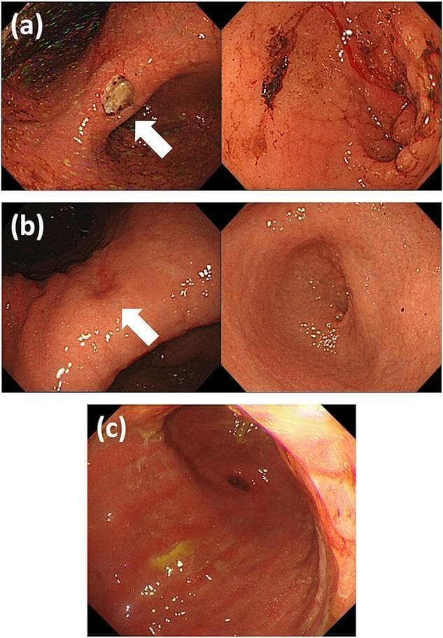 This set of clinical endoscopic photographs displays the progression of gastric pathology in a patient with metastatic invasive lobular carcinoma. Image (a) reveals a localized peptic-like ulcer at the gastric angle, indicated by a white arrow, characterized by a white fibrin base and surrounding reddish, granular mucosa. There is no evidence of pyloric stenosis at this stage. Image (b) shows the evolution to a healed ulcer (white arrow) alongside significant clinical progression: a diffusely thickened and stenotic pyloric ring is visible, indicative of linitis plastica-type changes. Image (c) demonstrates late-stage findings with diffuse tumor infiltration at the gastric antrum. The mucosa appears markedly inflamed, rigid, and exhibits yellowish exudative patches and friability. These images collectively illustrate the endoscopic presentation of gastric metastasis from breast cancer, highlighting the transition from a discrete ulcer to diffuse wall thickening and luminal narrowing characteristic of secondary linitis plastica.