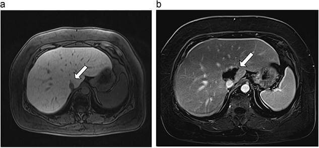 This Comparison Chart features two side-by-side axial MRI slices of the upper abdomen, illustrating a pre- and post-treatment scenario for a hepatic tumor. Image (a) is a pre-ablation MRI showing a 6 mm hypointense lesion located within the caudate lobe of the liver, indicated by a white arrow. The lesion is discrete and located near major vascular structures. Image (b) shows a post-ablation MRI taken 18 days after microwave ablation. The white arrow points to a significantly larger, 40.4 mm ablation site in the caudate lobe, characterized by altered signal intensity reflecting necrotic tissue change. Both images demonstrate the liver's anatomical relationship with the spleen (visible in the right side of the frame) and the abdominal vasculature. The educational focus is on the radiological assessment of microwave ablation success and the expected morphological changes following the procedure in the caudate lobe. This content is relevant for radiology and hepatobiliary surgical oncology training.