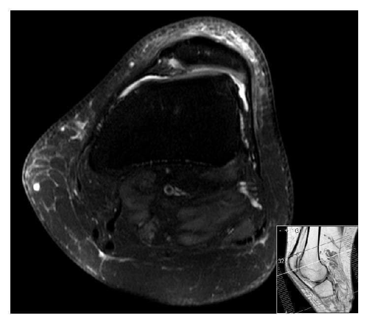 This diagnostic image is an axial T2-weighted MRI of the knee joint with fat suppression, illustrating severe trochlear dysplasia classified as Dejour type C. The primary visual findings include a characteristic convexity of the lateral femoral condyle paired with significant hypoplasia of the medial femoral condyle, resulting in a flat or even convex trochlear surface rather than a normal concave groove. The patella is clearly lateralized and exhibits a lateral tilt relative to the femoral trochlea, indicating patellofemoral instability. High signal intensity fluid is visible within the joint space, and there are signs of chondral thinning and loss along the patellar facets. This image serves as a clinical example for orthopedic and radiological evaluation of recurrent patellar dislocation and developmental anomalies of the knee extensor mechanism.