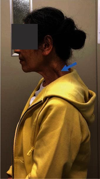 A clinical photograph presenting a lateral view of a patient’s head and neck, demonstrating Dropped Head Syndrome (DHS) with characteristic forward head posture. The image shows the head positioned anteriorly relative to the torso, with a marked forward inclination of the cervical spine. A blue arrow points to a distinct, abnormal bulge in the posterior neck region, corresponding to the trapezius and levator scapulae muscles. This visible hypertrophy or prominence indicates compensatory muscle strain or underlying musculoskeletal pathology associated with impaired cervical extension. The photograph was captured during the follow-up phase of athletic rehabilitation-based physical therapy (AR-PT), illustrating persistent muscle tonus despite symptomatic improvement. This visual serves as an educational example of postural deformity, sagittal imbalance, and compensatory myofascial changes in cervical spinal disorders.