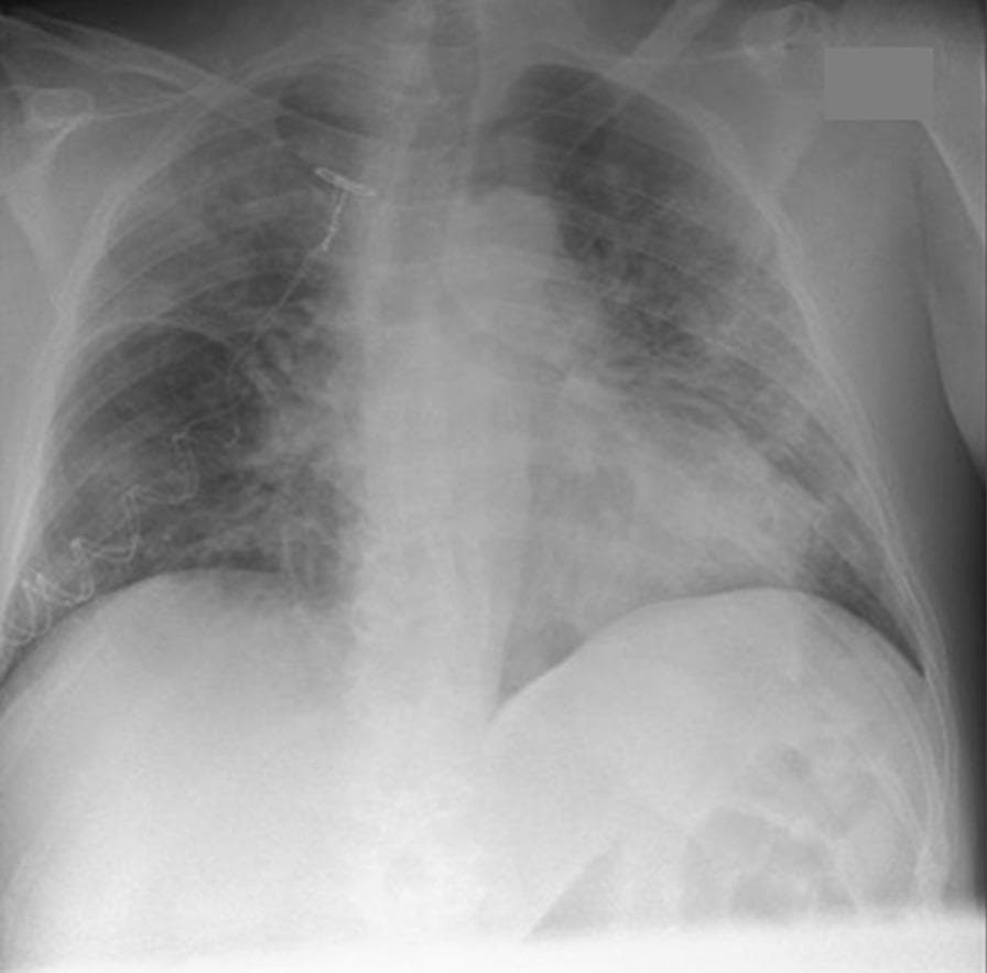 This diagnostic image is a frontal (anteroposterior) chest X-ray demonstrating severe pulmonary pathology. The primary findings are diffuse, bilateral lung opacities characterized by a mix of hazy ground-glass appearance and patchy consolidations. These infiltrates are widespread, showing a predisposition for the mid and lower lung zones, with relative sparing of the extreme apices. Such radiographic patterns are indicative of extensive alveolar and interstitial involvement, frequently seen in viral pneumonia, specifically SARS-CoV-2 (COVID-19), or acute respiratory distress syndrome (ARDS). Anatomically, the cardiac silhouette and mediastinal borders are partially obscured by the overlying parenchymal density. A radiopaque medical device, consistent with a central venous catheter or similar vascular access line, is visible in the upper right thoracic region, extending toward the superior vena cava. This visual is educationally significant for demonstrating the radiographic manifestation of severe lower respiratory tract infection and the progression to bilateral pulmonary infiltrates requiring intensive clinical management.