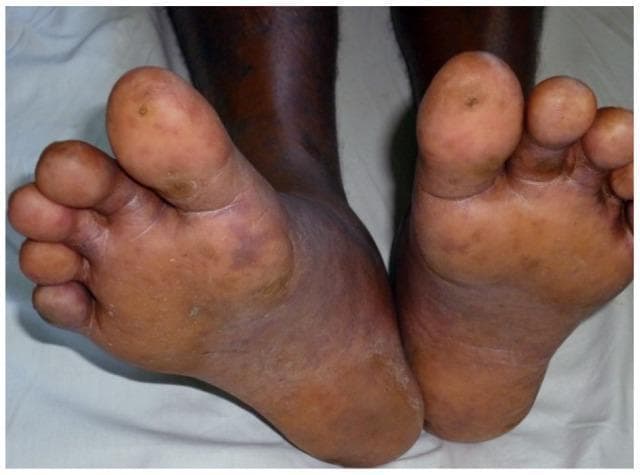 This clinical photograph displays the plantar surfaces and toes of both feet, demonstrating a vasculitic rash characteristic of Spotted Fever Group (SFG) rickettsiosis. The lesions are distributed across the soles and toes, appearing as discrete, dusky red to dark brown macules and papules against a dark skin background. Some lesions exhibit necrotic changes, particularly visible as darkened, crust-like centers on the distal phalanges of the great toes. Morphologically, the spots are predominantly round to oval, ranging approximately 2–10 mm in size, with areas of healthy, normal-looking skin interspersed between the affected sites. Secondary skin features include generalized dryness, focal desquamation (peeling) on the toes, and mild pedal edema. Clinically, these findings represent cutaneous small-vessel vasculitis and microvascular thrombosis typical of rickettsial infection, providing an important diagnostic clue for systemic infectious diseases presenting with dermatological manifestations in the extremities.