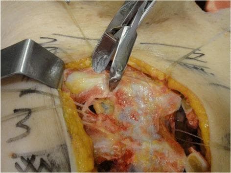 This clinical photograph captures a surgical procedure involving the resection of costal cartilage at the sternal junction, likely during a thoracic dissection or access procedure. The central focus is on a small metallic costotome (cartilage-cutting instrument) as it engages with the pale, whitish, and semi-translucent costal cartilage. The surgical field is exposed via a median longitudinal incision, held open by a metal retractor. Multiple tissue layers are discernible: the outermost yellow subcutaneous adipose tissue, underlying reddish-pink intercostal musculature, and associated connective tissues. Visible anatomical landmarks include the parasternal region where the cartilage joins the sternum. Pre-operative or intra-operative markings are visible on the skin surrounding the incision. The image demonstrates the precise mechanical step of chondrotomy, essential for procedures requiring rib cage expansion or internal thoracic artery/node access. It serves as an educational resource for thoracic surgery, surgical anatomy of the chest wall, and instrument application.
