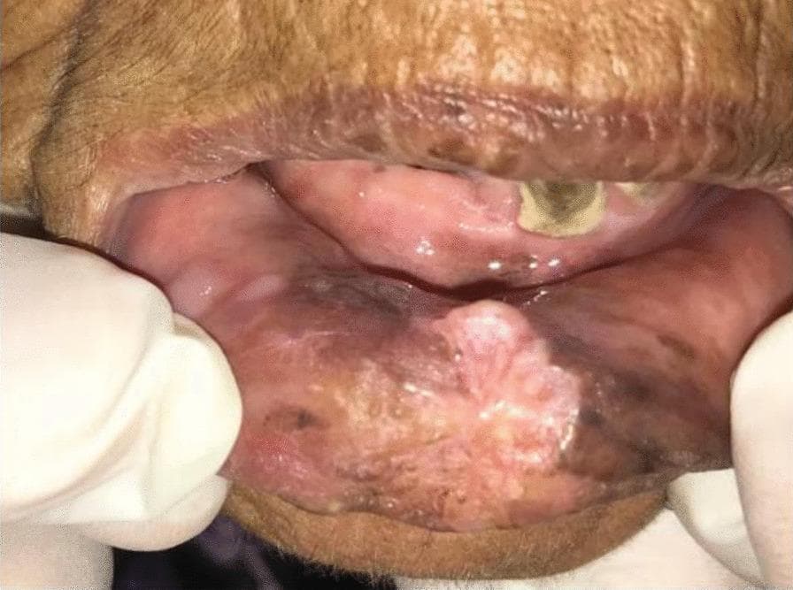 Clinical photograph of the oral cavity and lower lip in a 70-year-old patient, demonstrating an exophytic, verrucous lesion consistent with Oral Squamous Cell Carcinoma (OSCC). The lesion on the lower lip is characterized by a mixed red-white (erythroplakic and leukoplakic) appearance with an irregular, cauliflower-like texture. Significant dark hyperpigmentation and discoloration are visible in the surrounding labial mucosa. Intraoral examination reveals severe dental staining, particularly on the upper dentition, and mucosal changes on the upper gingiva including white patches and areas of erythematous inflammation. The overall presentation is characteristic of long-term tobacco or khat use, illustrating the progression from chronic mucosal irritation to verrucous carcinoma. This image serves as an educational example for identifying premalignant and malignant oral lesions during clinical screening.