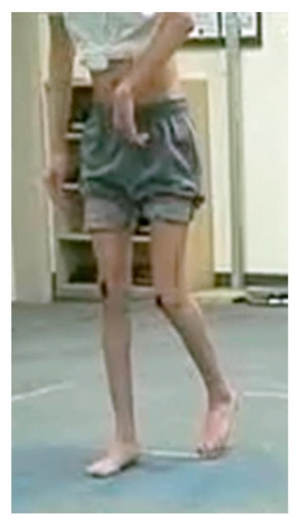 Clinical photograph of a patient with hemiplegic cerebral palsy demonstrating a characteristic asymmetrical gait pattern and upper extremity posturing. The upper limb on the involved side exhibits a significant elbow flexion contracture (greater than 30 degrees), with the hand held in close proximity to the trunk and the wrist in a flexed position. The lower extremities show distinct gait abnormalities: the limb in the stance phase displays knee recurvatum (hyperextension), while the contralateral advancing limb shows a straighter knee alignment with the foot in dorsiflexion. This visual represents a Winters classification type gait analysis, emphasizing spastic posturing and compensatory movement strategies in spastic hemiplegic cerebral palsy (SHCP). The image is used for educational purposes to illustrate motor impairment, pelvic retraction context, and the visual assessment of dynamic gait abnormalities in pediatric orthopedics and physical medicine.